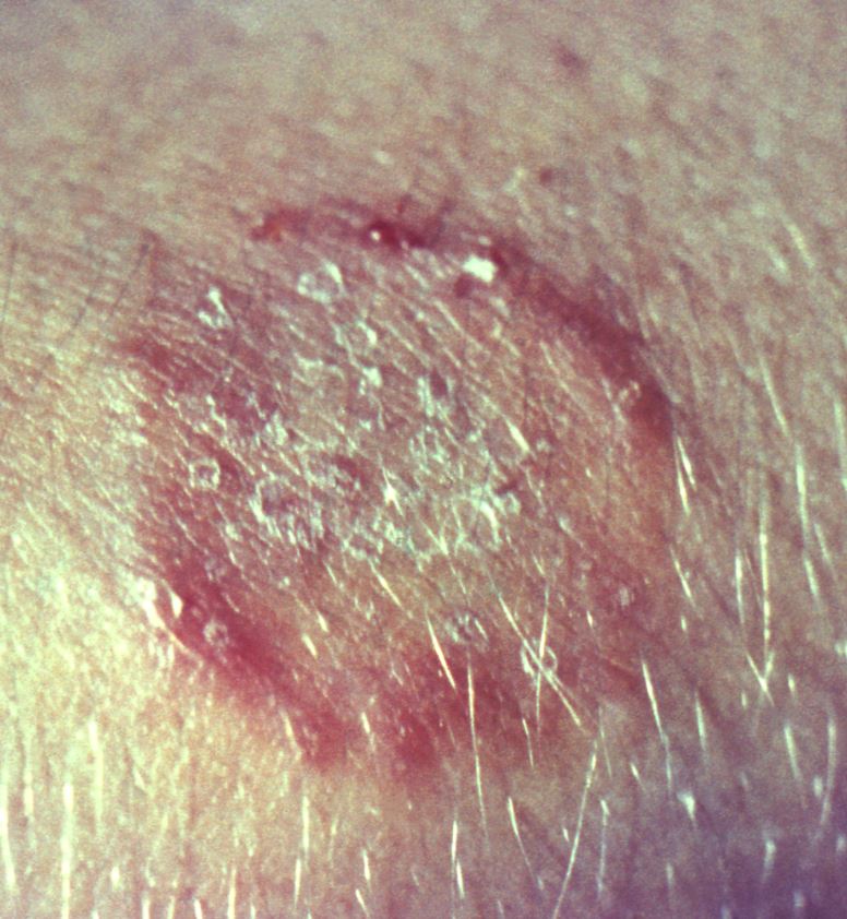 Quick takes Antifungalresistant ringworm, avian flu in sea lions, dengue in Italy CIDRAP